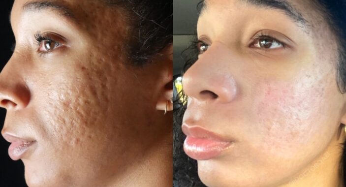 10 efectivos tratamientos para piel acneica: descubre cómo deshacerte del acné