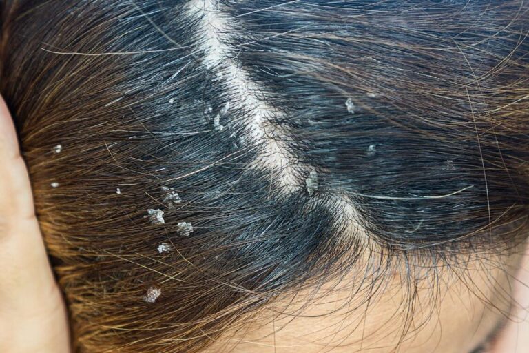 10 formas efectivas de quitar la caspa y tener un cuero cabelludo saludable