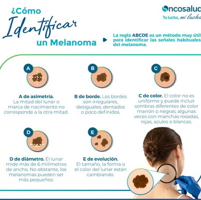 Descubre cómo detectar melanoma: Consejos y señales a tener en cuenta