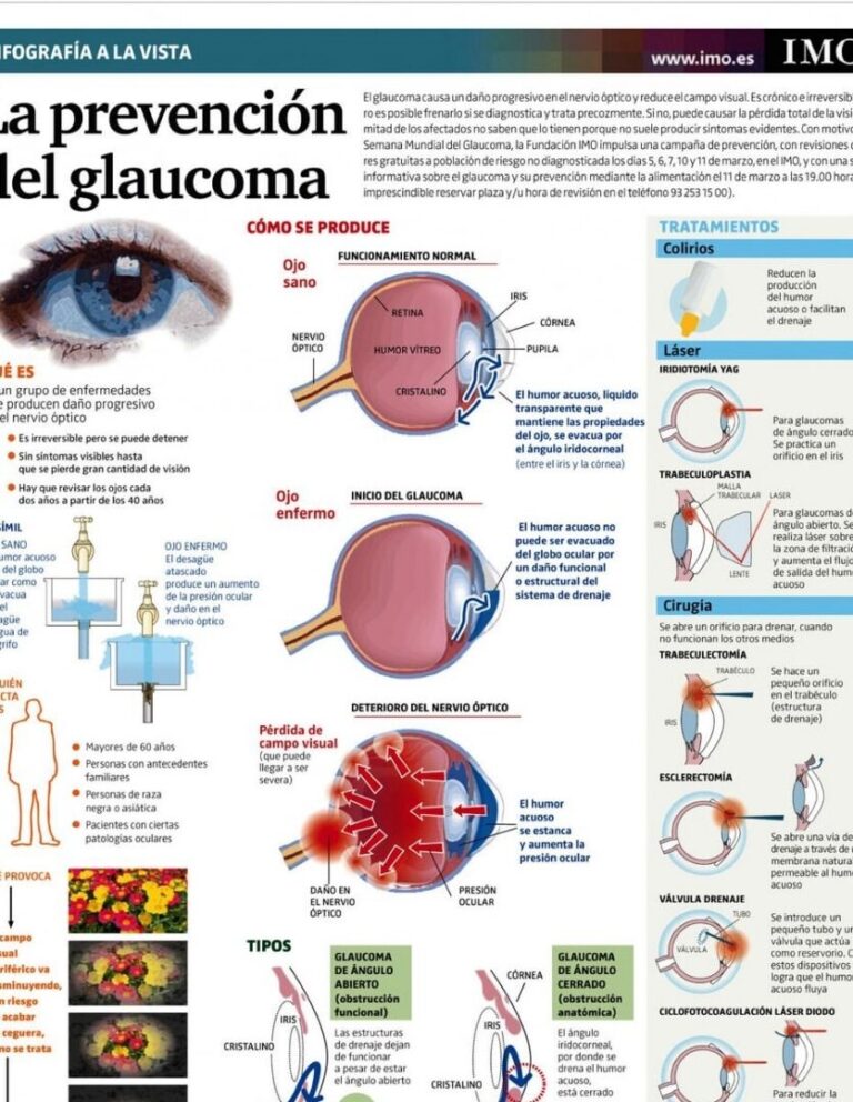 Glaucoma: Una guía completa sobre qué es y cómo prevenirlo
