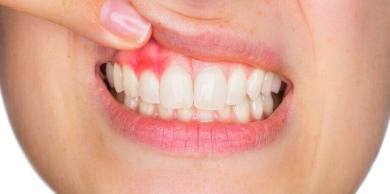 Qué es la gingivitis: todo lo que debes saber sobre esta enfermedad bucal