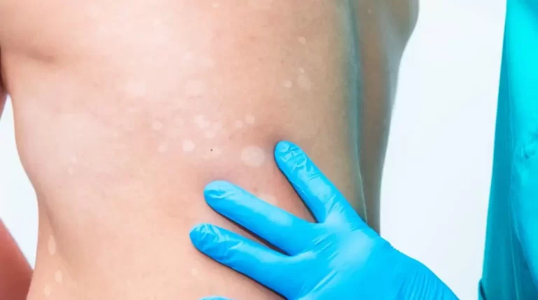 Todo lo que debes saber sobre el vitiligo, una enfermedad de la piel