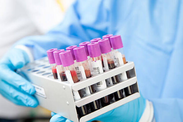 Tratamientos del lupus: todo lo que debes saber